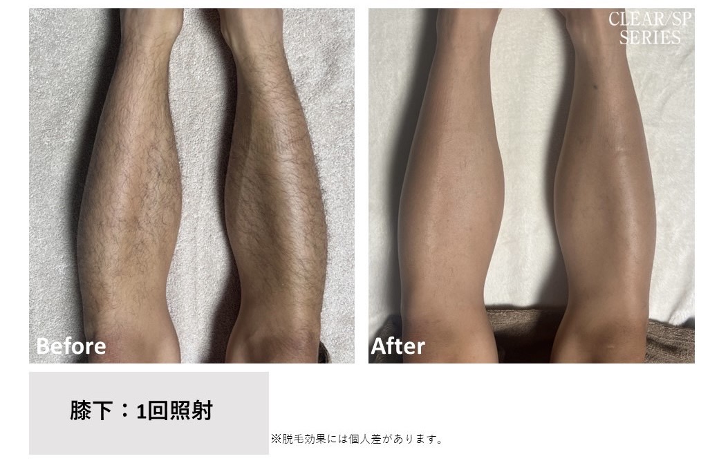 メンズ脱毛施術写真2