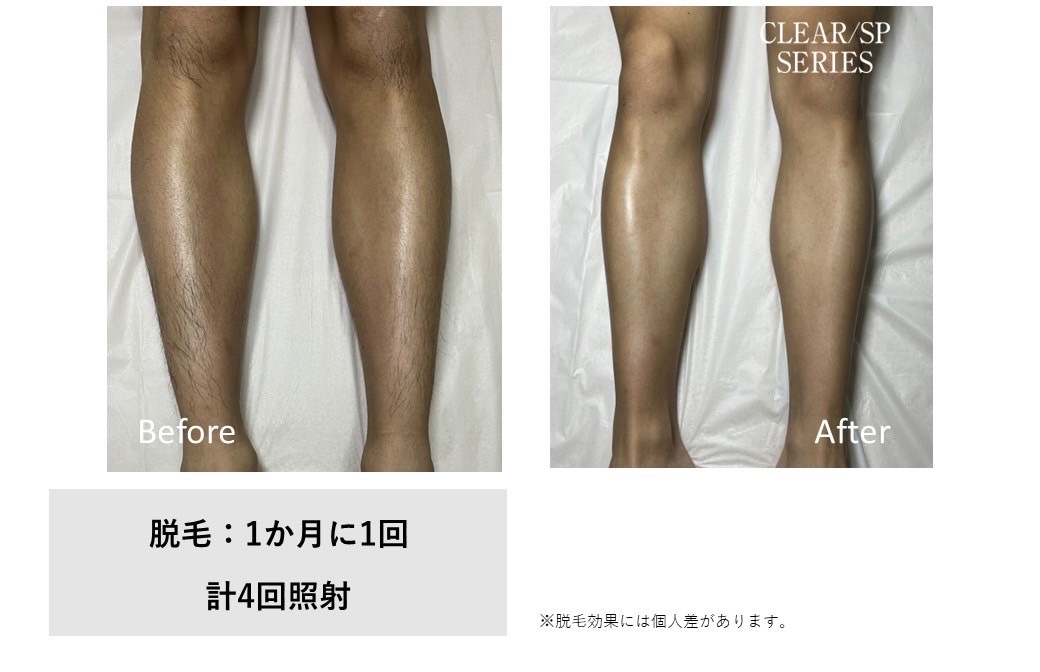 メンズ脱毛施術写真4