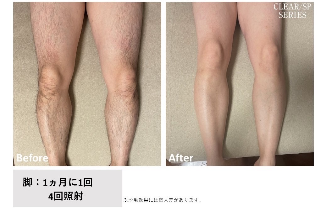 メンズ脱毛施術写真5