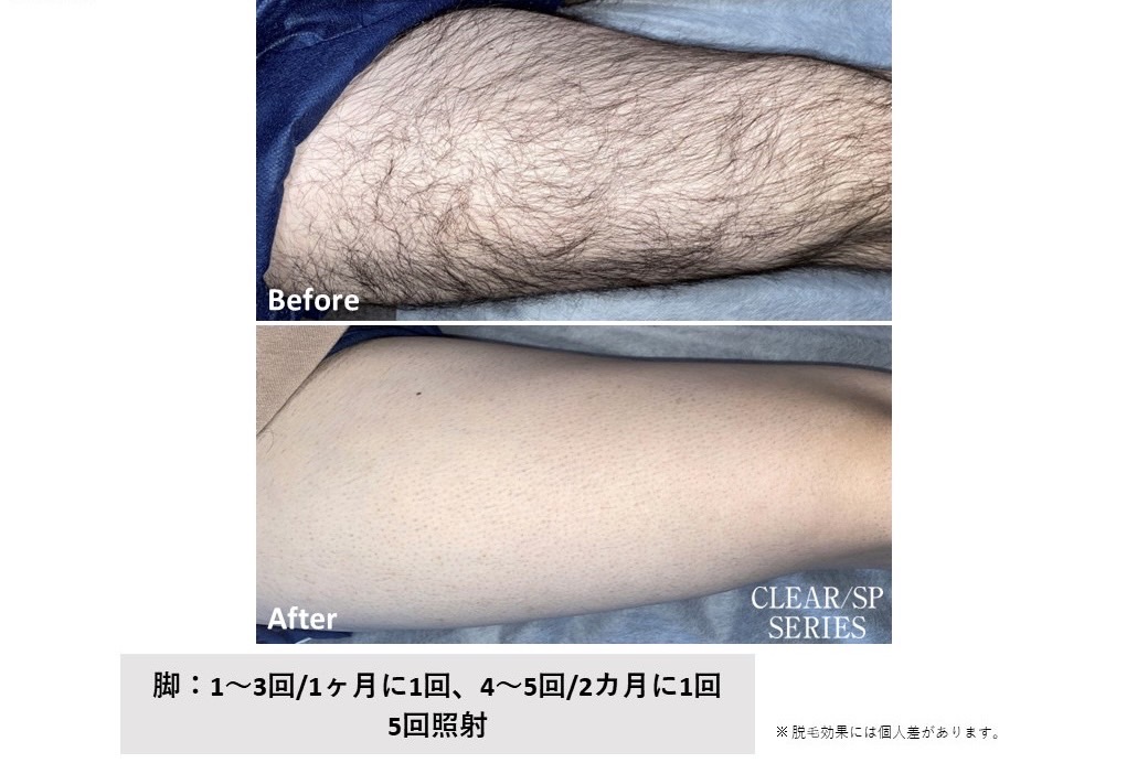 メンズ脱毛施術写真6