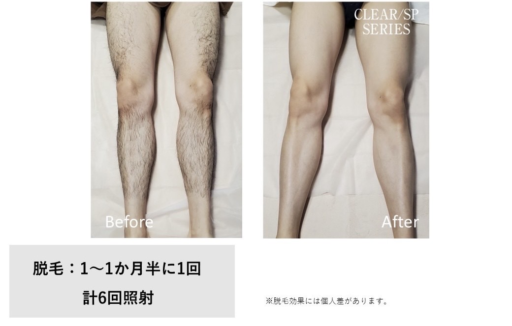 メンズ脱毛施術写真7