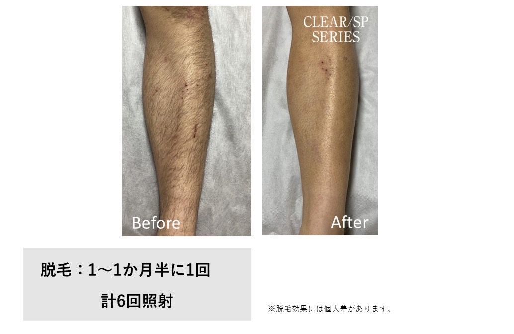 メンズ脱毛施術写真8