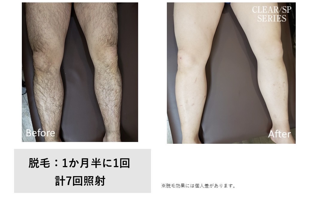 メンズ脱毛施術写真9