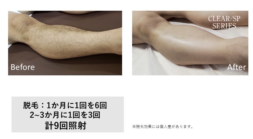 メンズ脱毛施術写真10