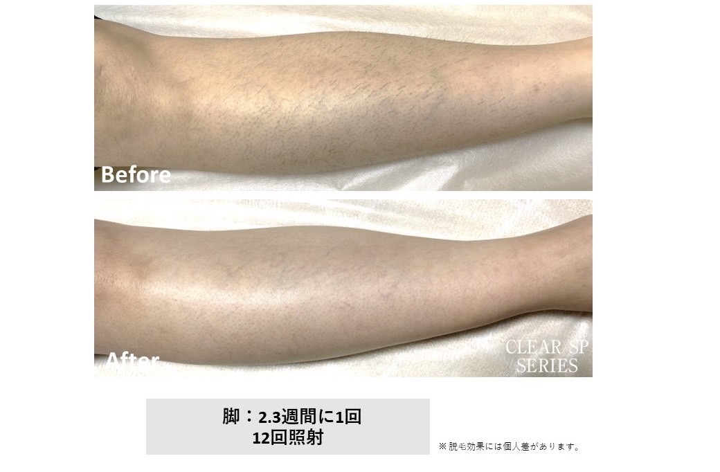 メンズ脱毛施術写真12