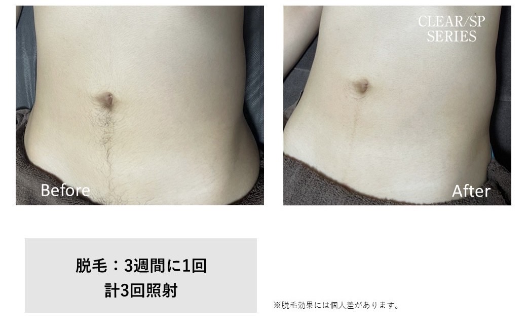 メンズ脱毛施術写真13