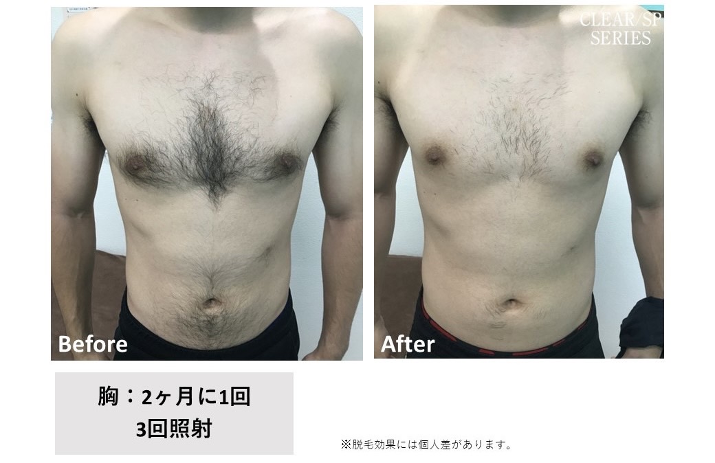 メンズ脱毛施術写真15