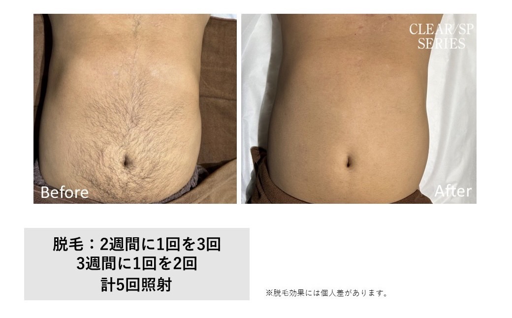 メンズ脱毛施術写真17