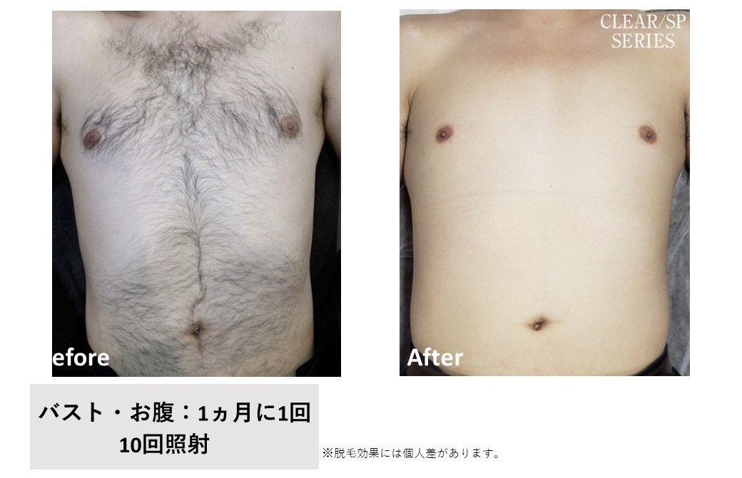 メンズ脱毛施術写真18