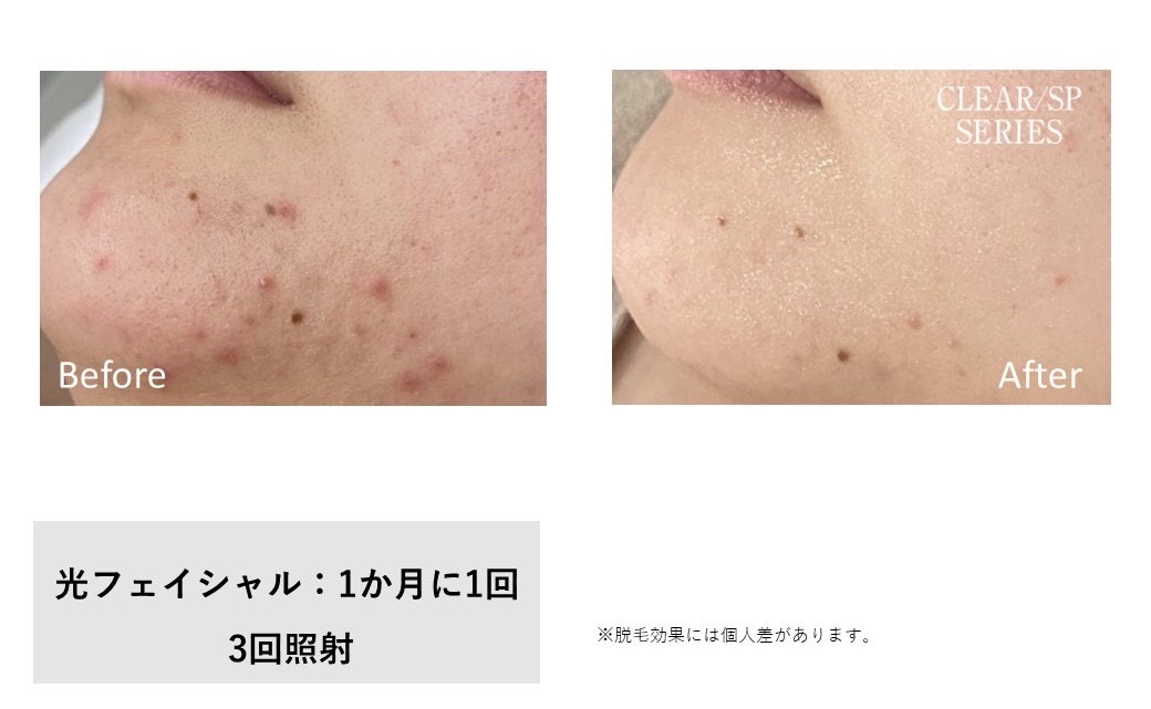 レディース脱毛施術写真12