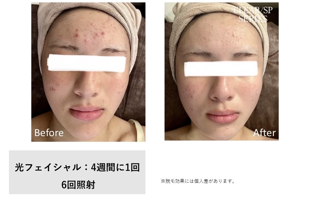 レディース脱毛施術写真13