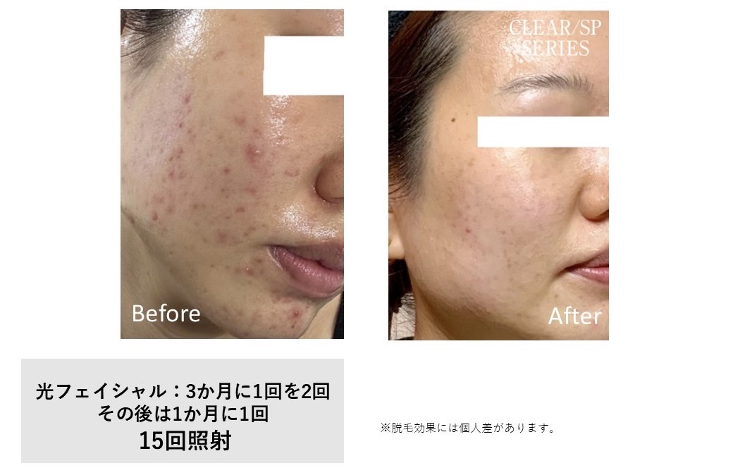 レディース脱毛施術写真14