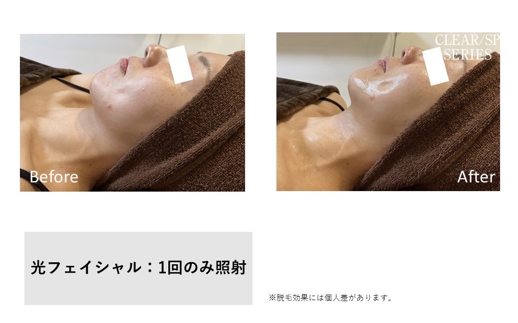 レディース脱毛施術写真18