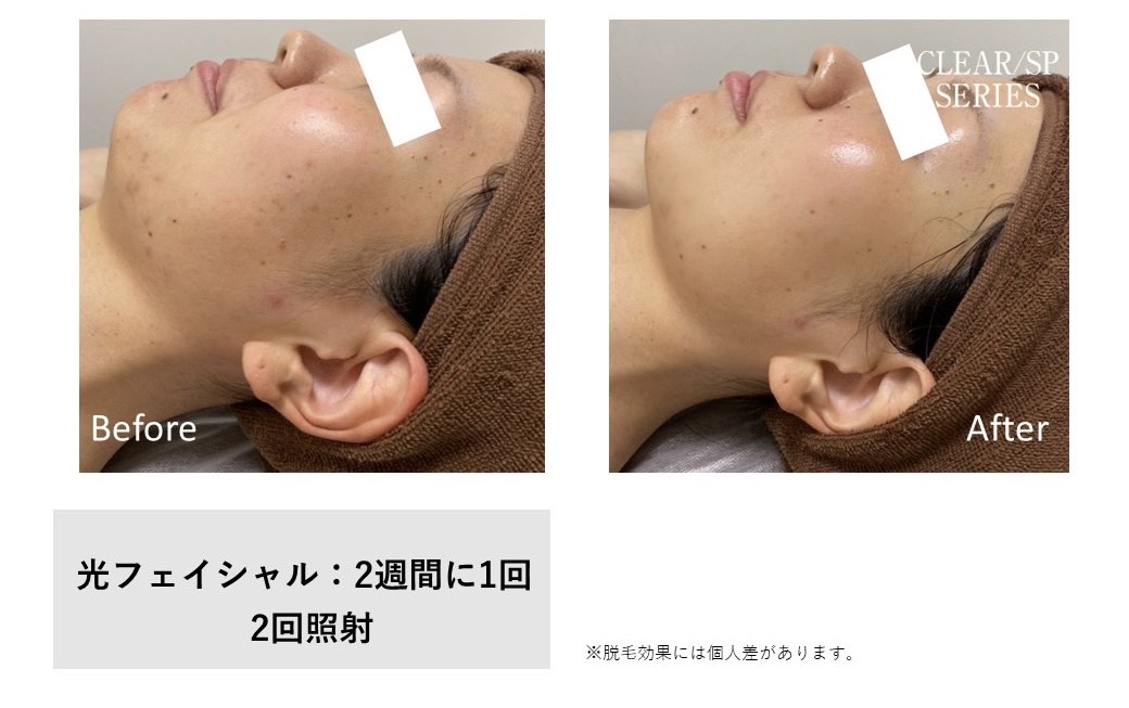 レディース脱毛施術写真19