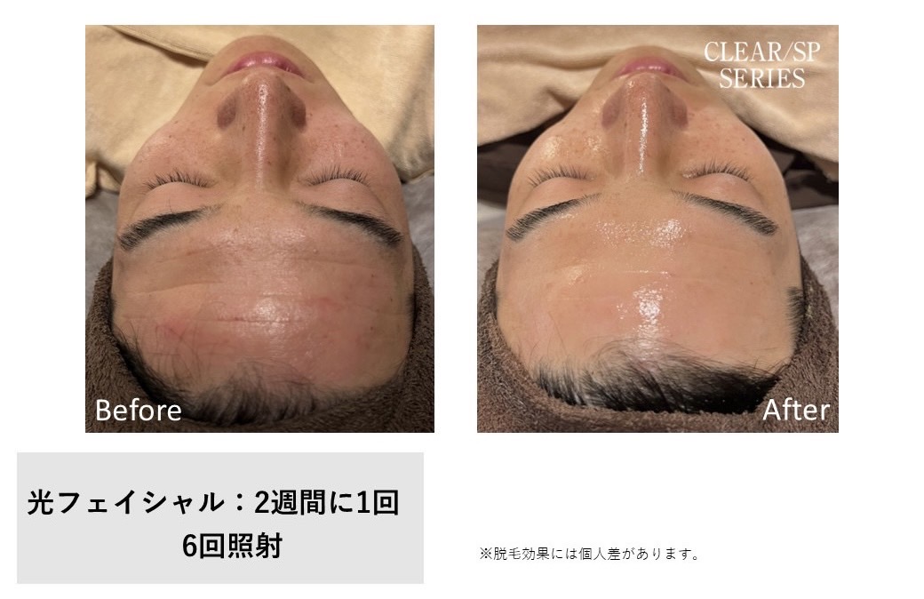 レディース脱毛施術写真22