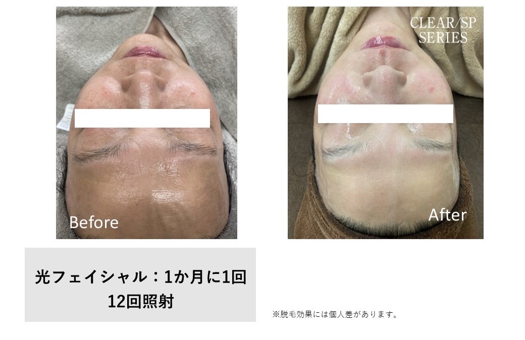 レディース脱毛施術写真23