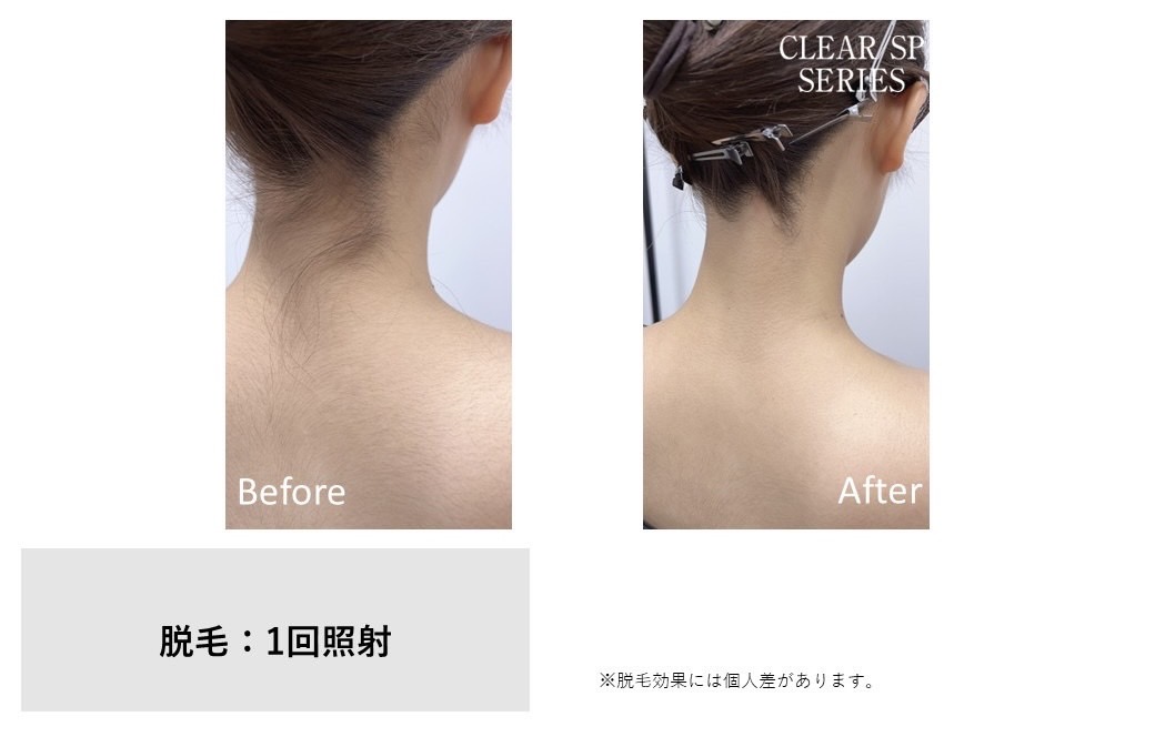 レディース脱毛施術写真1