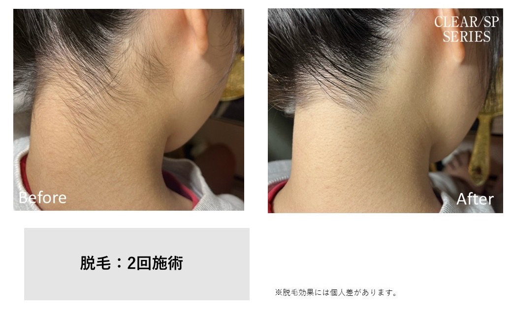 レディース脱毛施術写真4