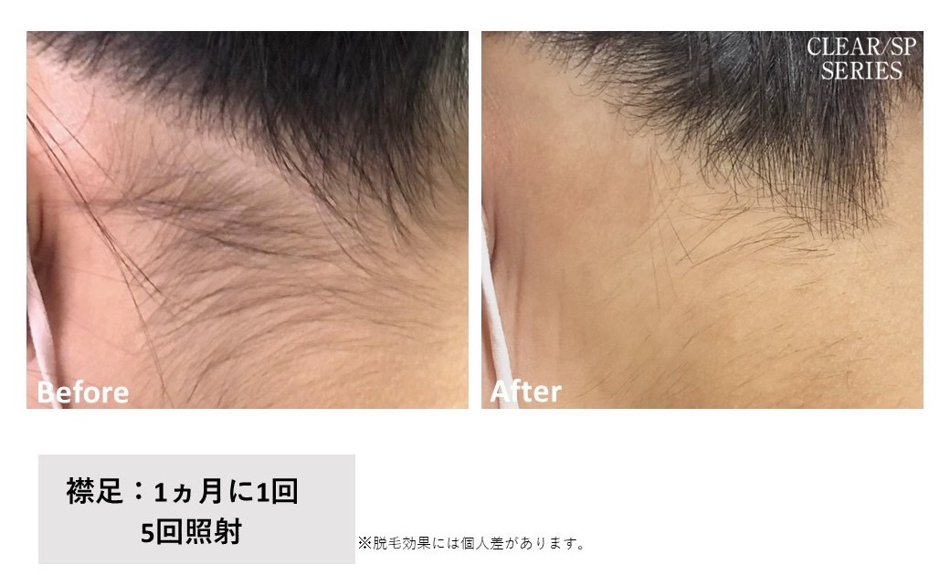 レディース脱毛施術写真7