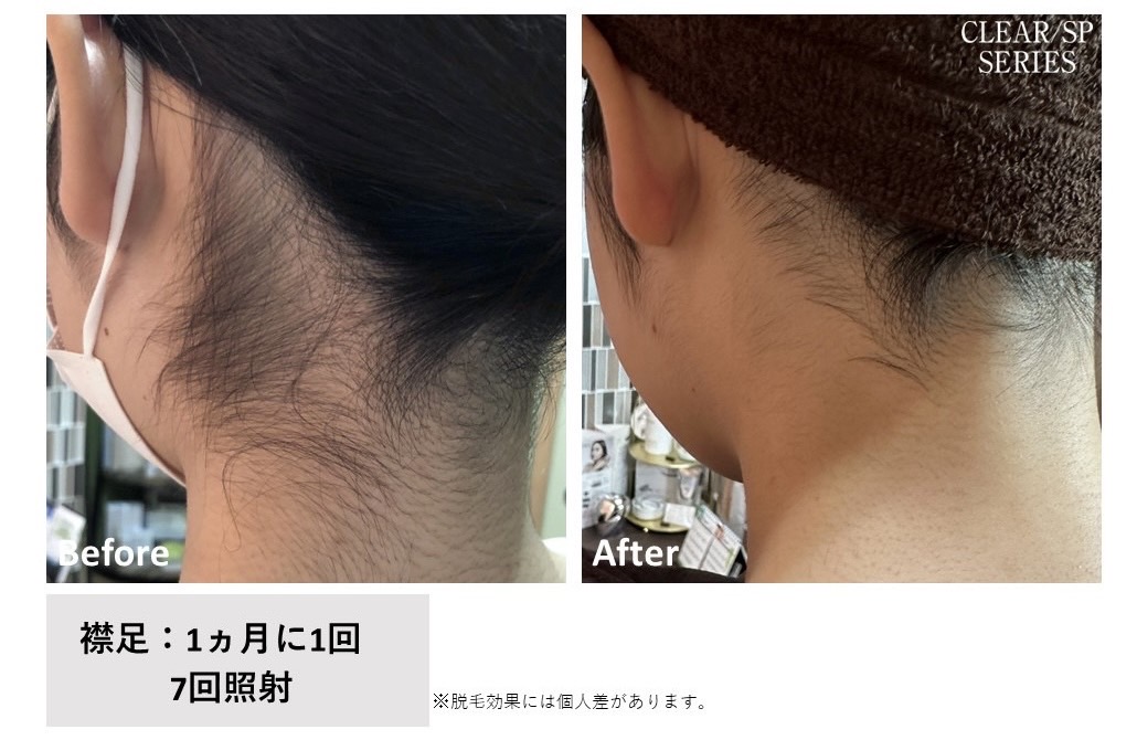 レディース脱毛施術写真9