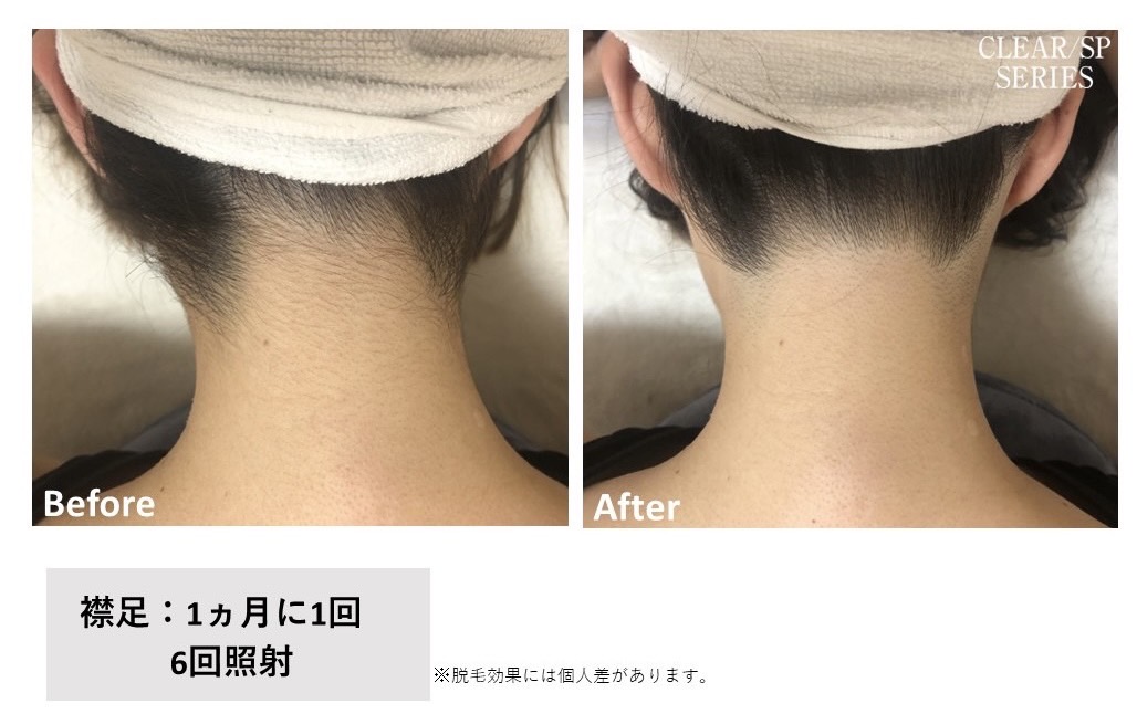 レディース脱毛施術写真11